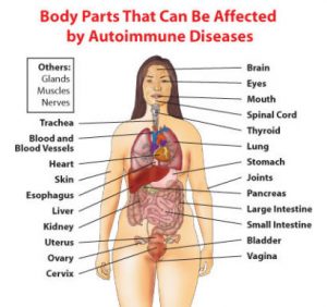 Why do so many people have autoimmune diseases?
