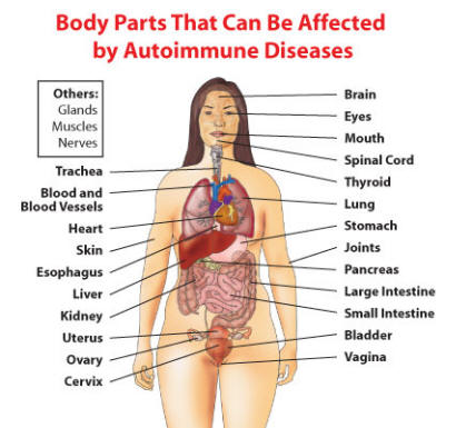 Why do so many people have autoimmune diseases?