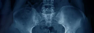 A New Non-Invasive Option for Pelvic Floor Weakness and Bladder Leakage in Cornelius NC